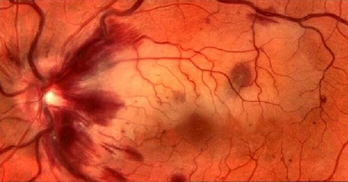 Vasos sanguíneos da retina e residualización da visión